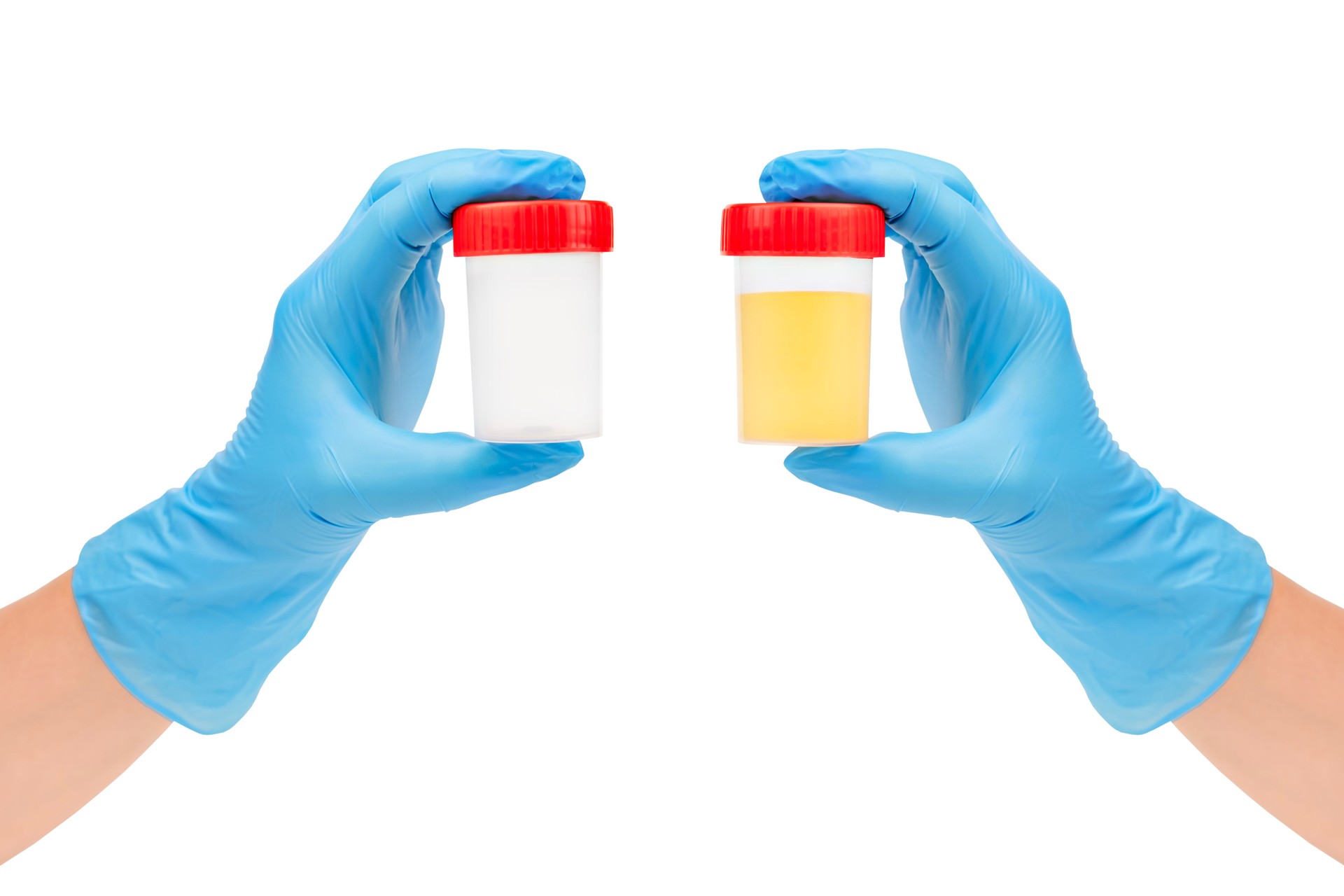 Hands in blue gloves holding empty urine sample container and urine test tube isolated on white background